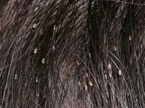 Mẹ con cùng nhập viện vì dùng cách nguy hiểm để diệt chấy