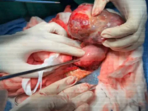 Em bé thường xuyên ọc sữa, nhập viện mới biết mắc bệnh cực hiếm